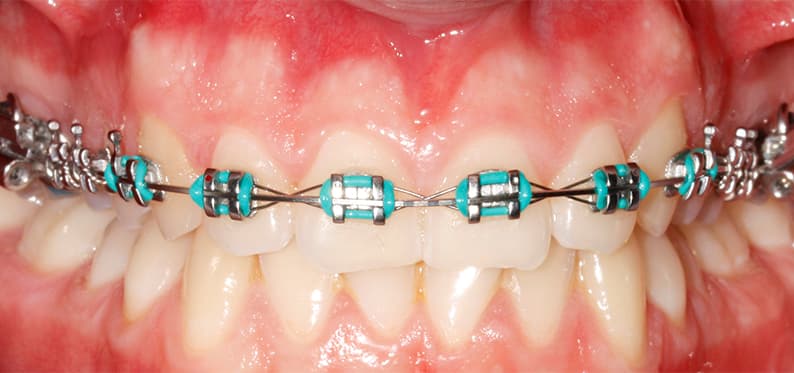 invisalign kraków